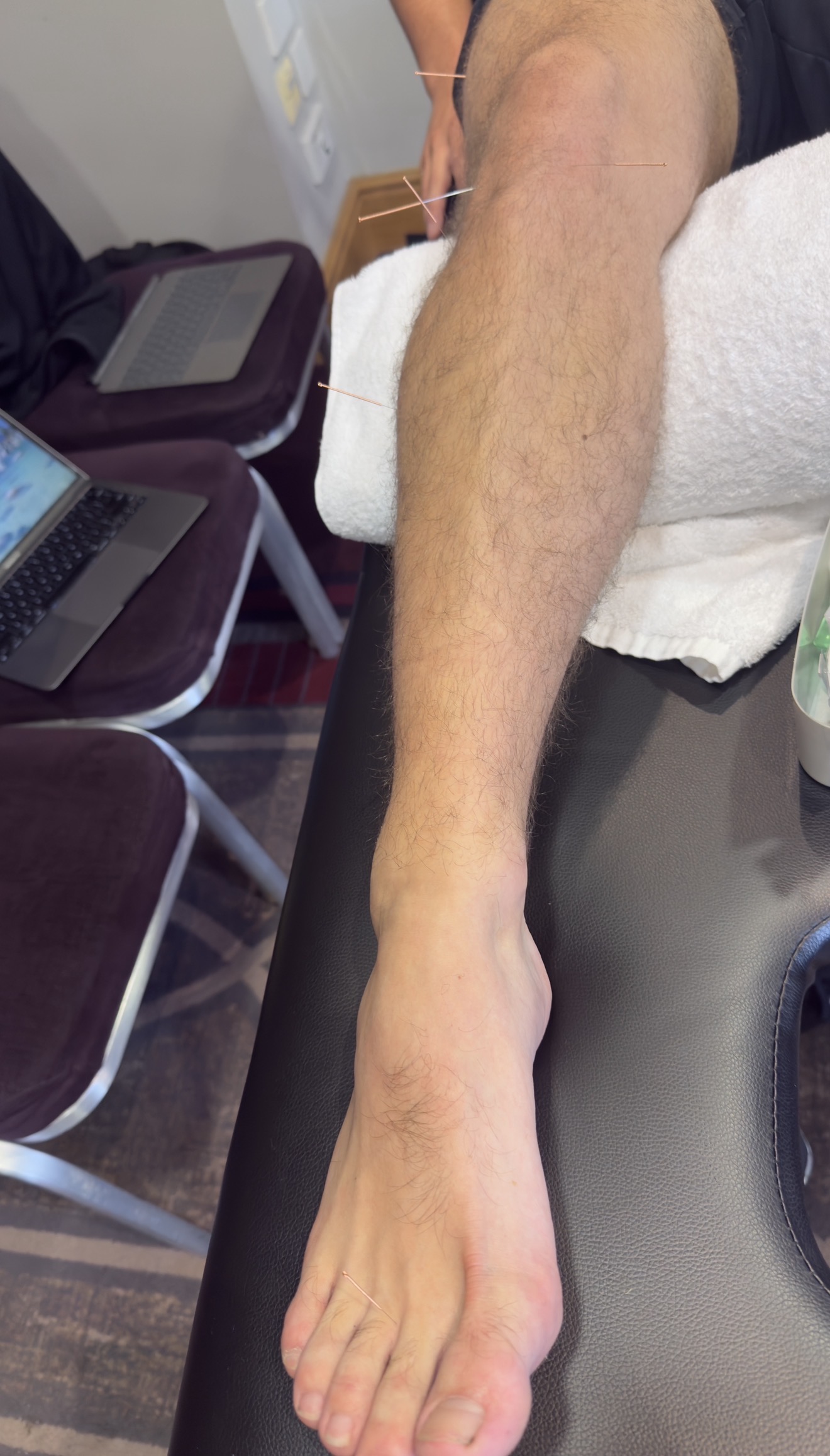 Acupuncture needles placed in a client’s lower leg and foot