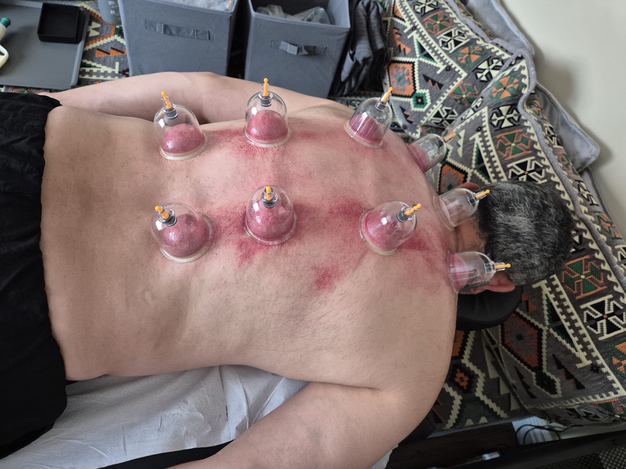 Dry cupping treatment with cups applied to a client&rsquo;s back