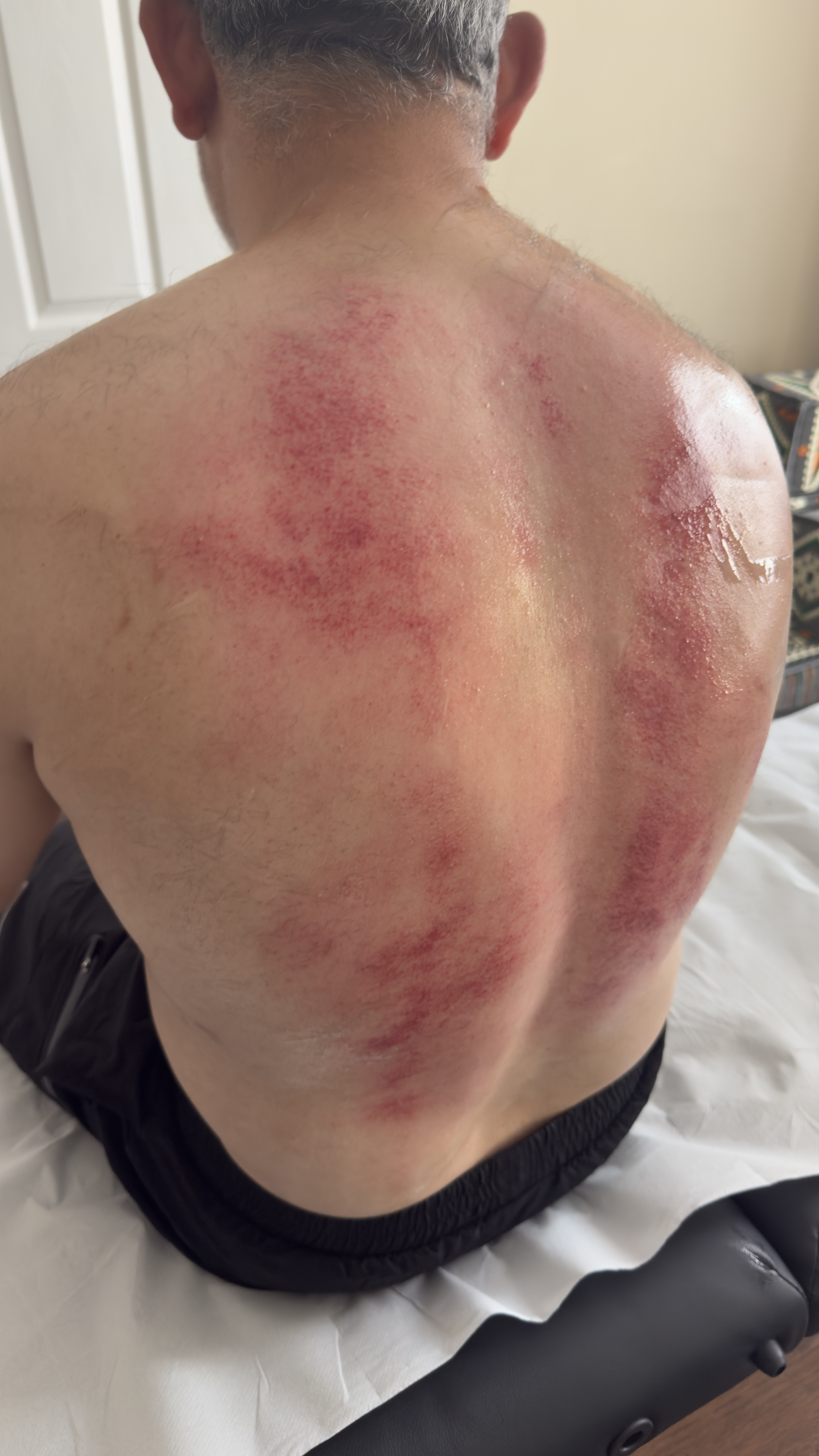 Graston Therapy treatment at The SAF Clinic