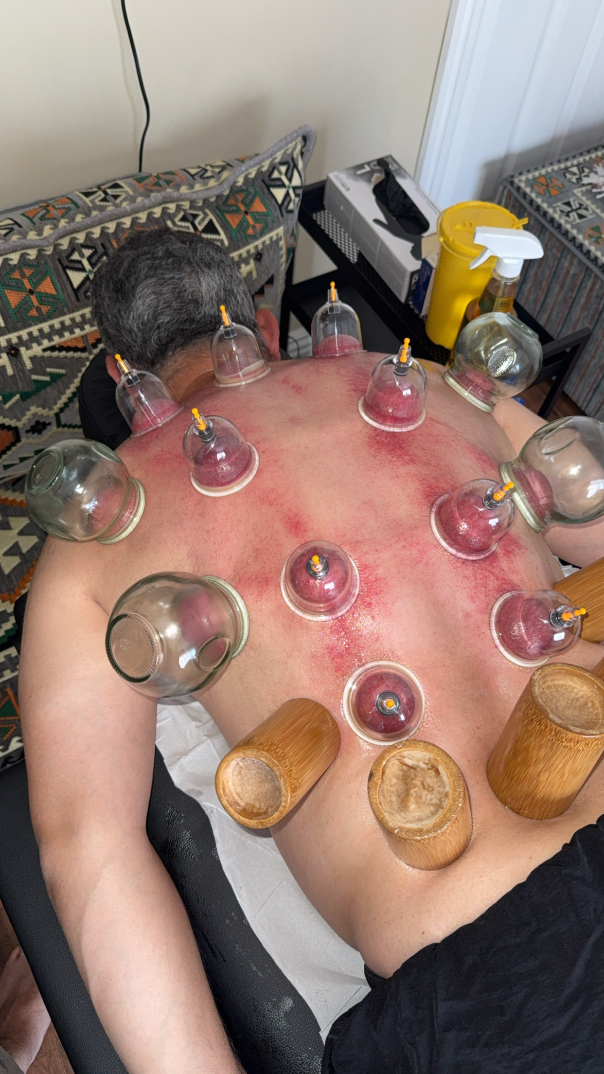 Cupping treatments included in the Ultimate Recovery Package