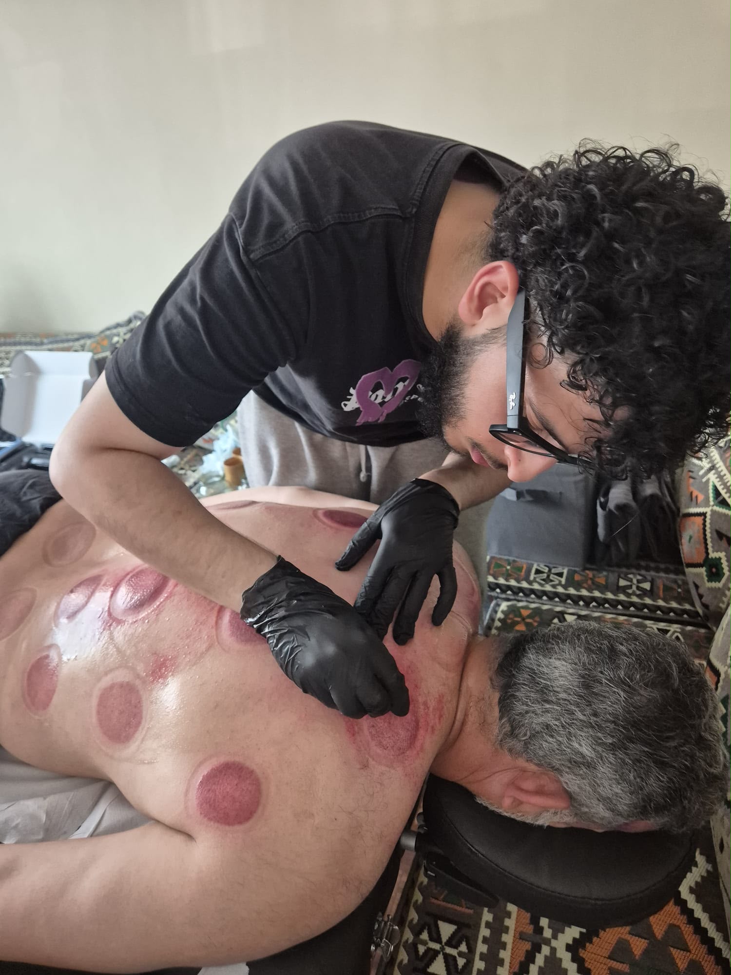 Wet cupping cups applied during treatment