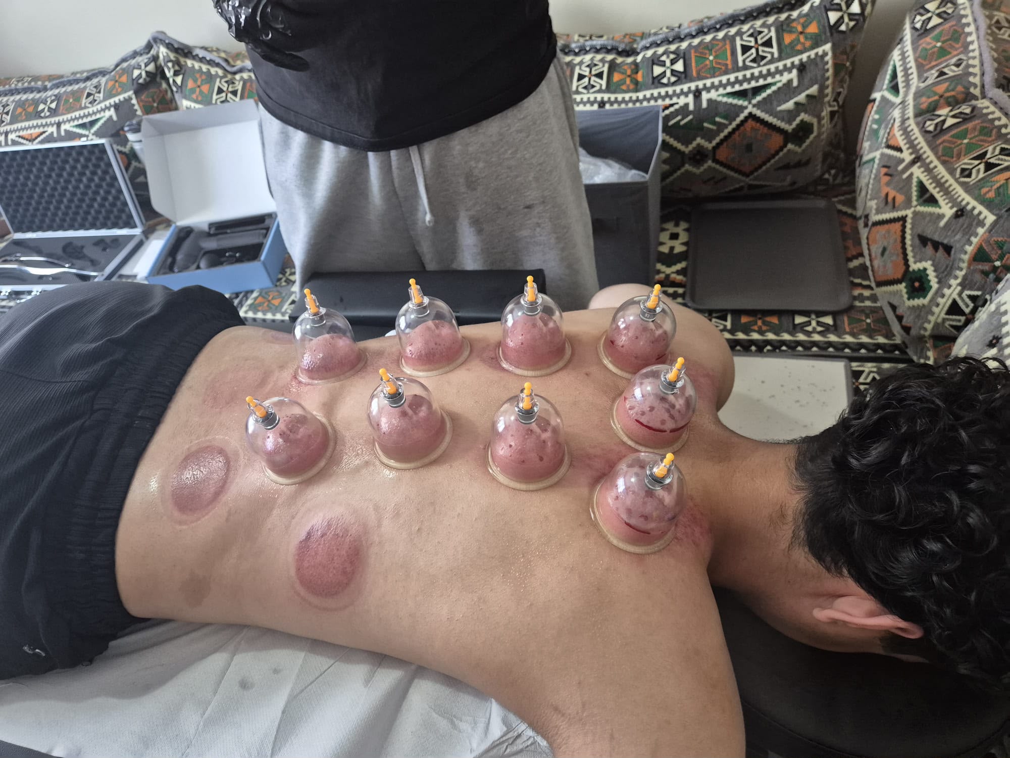 Wet cupping treatment marks following a treatment session