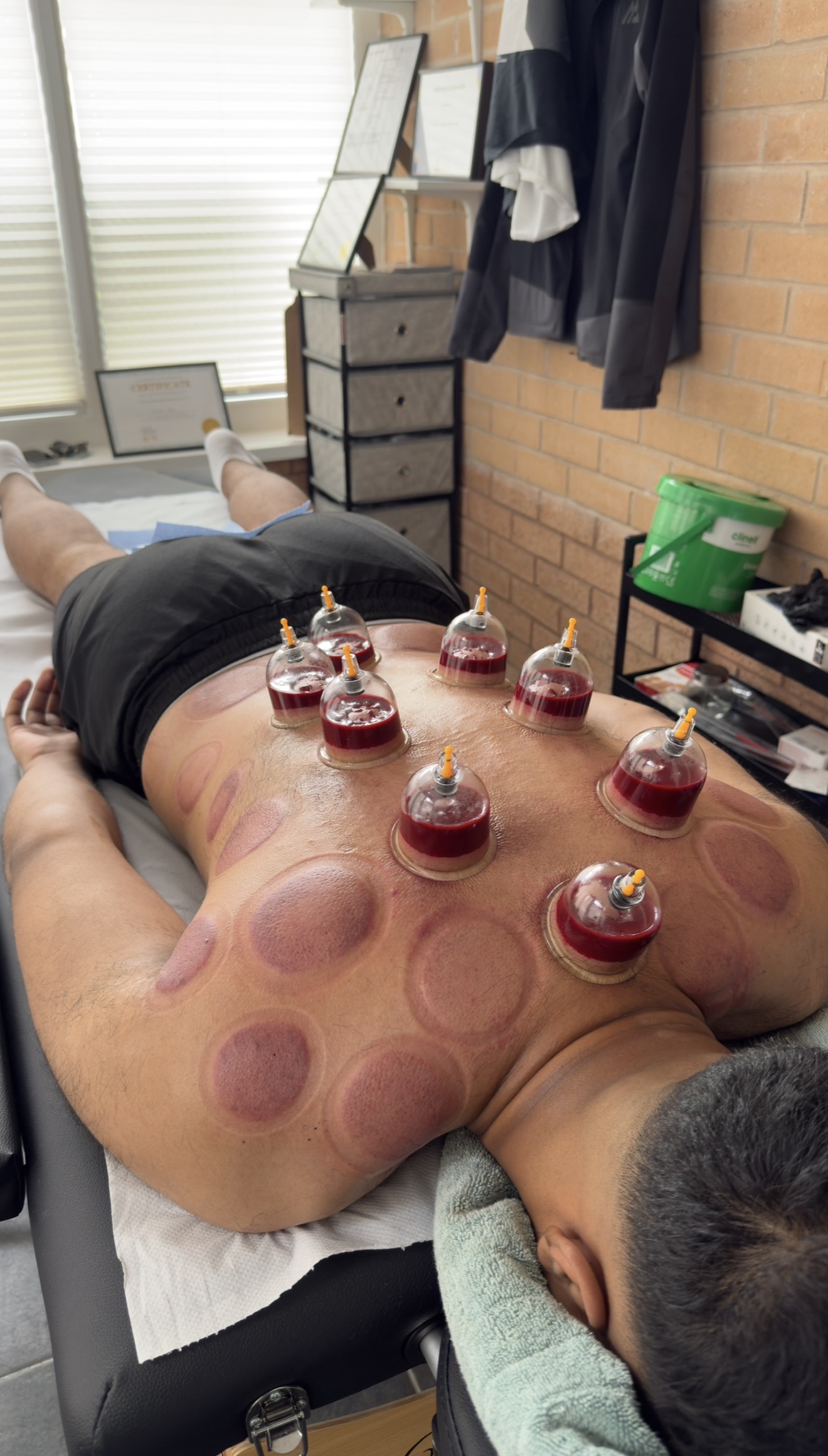Wet cupping cups applied to a client’s back during Hijama treatment